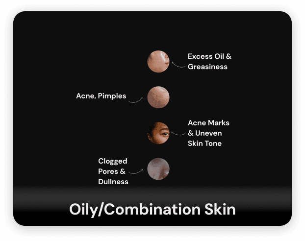 Woman with oily skin showing various skin concerns